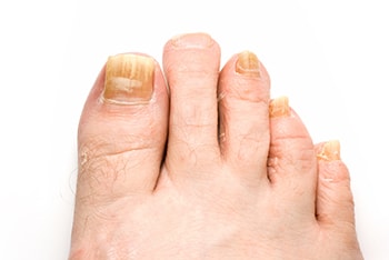 Fungal Toenails