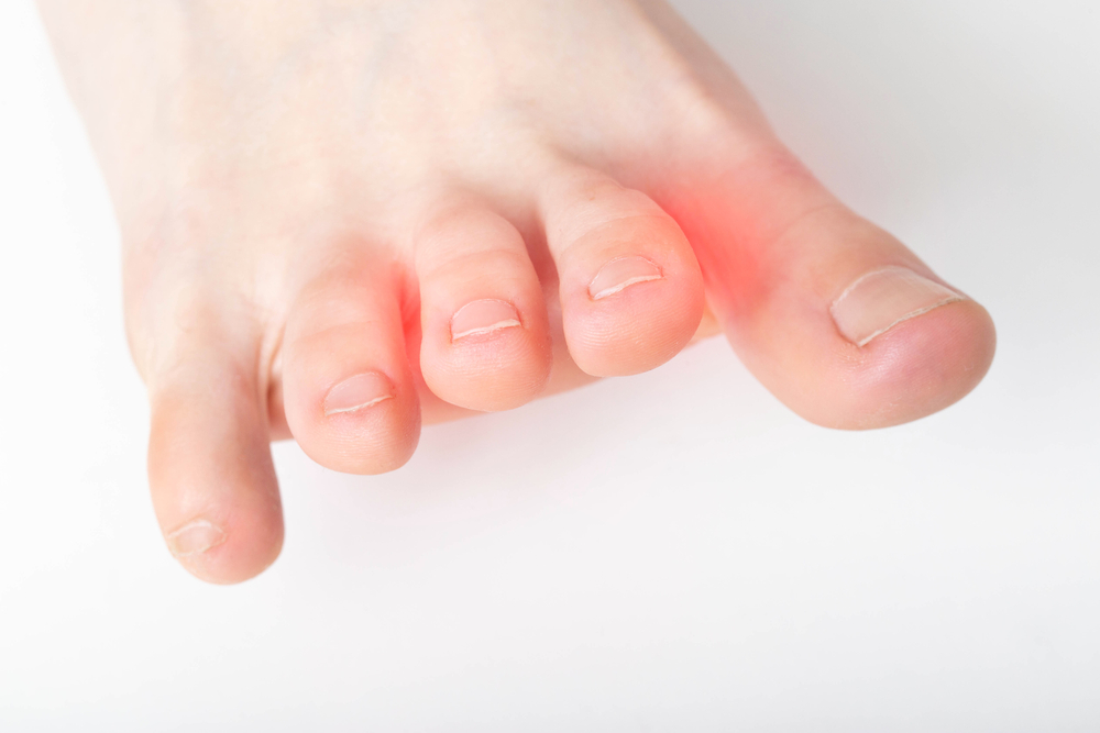 Will a Neuroma Go Away on Its Own?